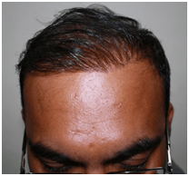 success story &#8211; fue hair transplant with 1500 grafts