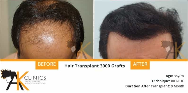 success story – 3000 grafts bio-fue hair transplant surgery result after 1.5 years