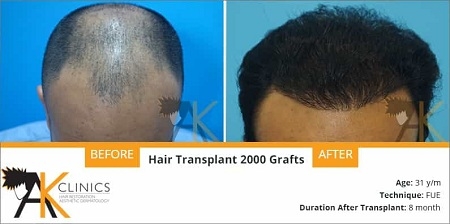 success story &#8211; 31 year old patient surgery result (2000 grafts with fue technique)