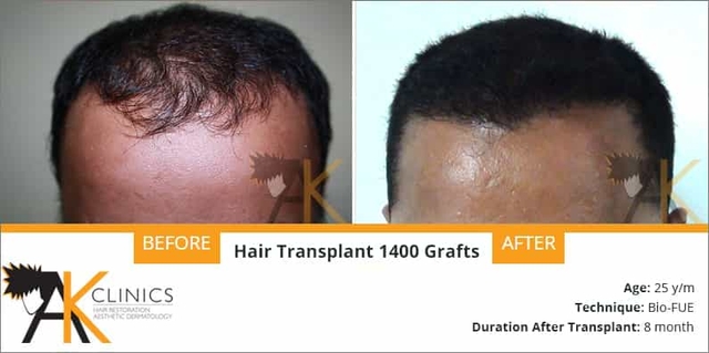 success story &#8211; 1400 grafts fue hair transplant surgery result after 8 month