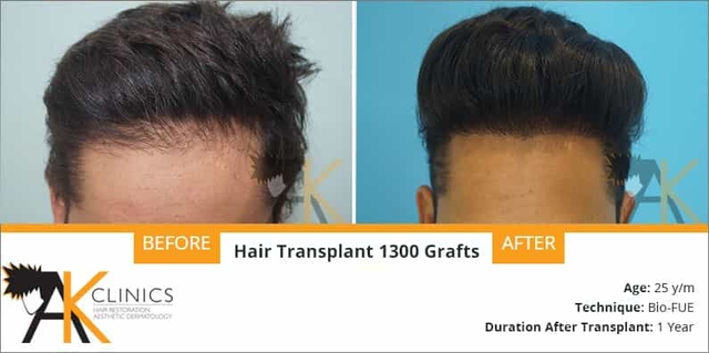 success story – 1300 grafts bio-fue hair transplant surgery result after 1 year