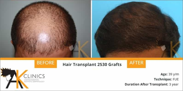 success story – 2530 grafts fue hair transplant surgery result after 3 years