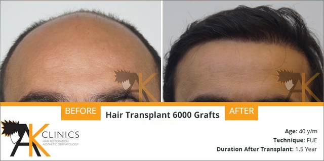 8600 grafts fue hair transplant in 3 session of afghanistan patient