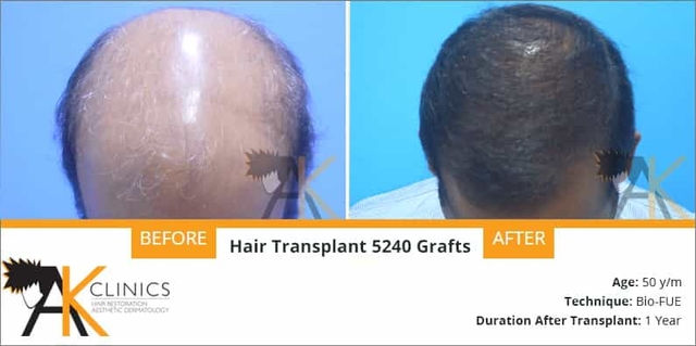 success story – 5240 grafts body hair transplant surgery result after 1 years