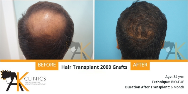 success story – 2000 grafts hair transplant surgery result after 6 months