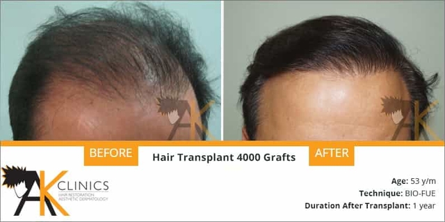 success story – 4000 grafts hair transplant surgery result after 1 year