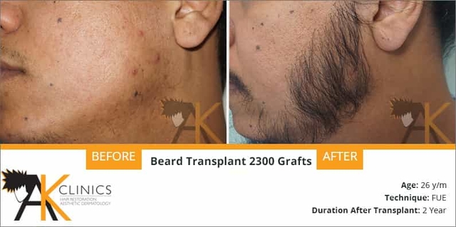 2300 grafts beard hair transplant surgery result after 2 year