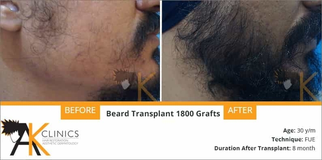 1800 grafts beard hair transplant surgery result after 8 months