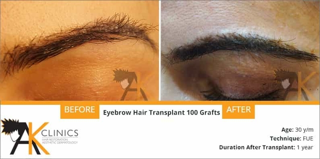success story – eyebrow hair transplant results after 1 year