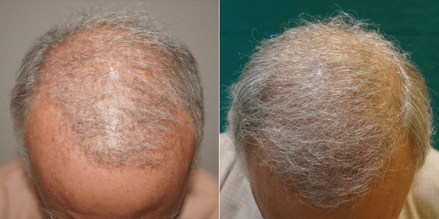 63 year old australian patient  4730 grafts body hair transplant