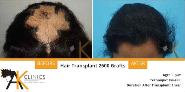 2600 grafts female hair transplant surgery result after 1 year