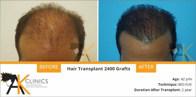 hair transplant result of 2400 grafts with bio fue technique