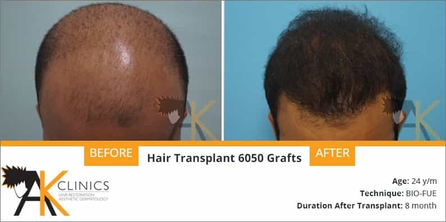 hair transplant result after 8 months by bio-fue technique
