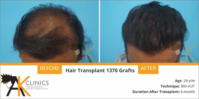 hair transplant result &#8211; 1370 grafts &#8211; bio fut technique