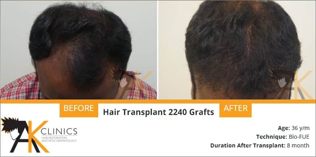 2240 grafts with bio fue technique result after 8 months