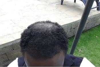 hair transplant result of 33 year old curly hair patient