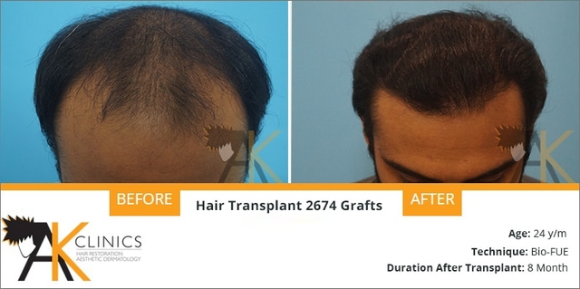 24 year old patient result with bio fue technique