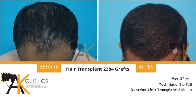 bio fue hair transplant result after 8 months &#8211; 2284 grafts