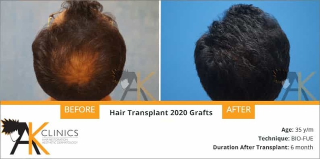 2020 grafts hair transplant surgery result after 6 months