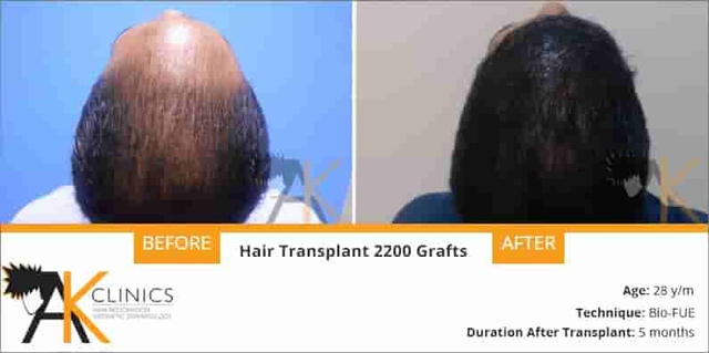 hair transplant result of 2200 grafts with bio fue technique