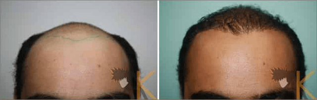 success story -fue hair transplant 2000 grafts grade 5