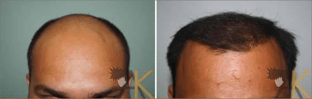 success story &#8211; strip hair transplant with 3000 grafts