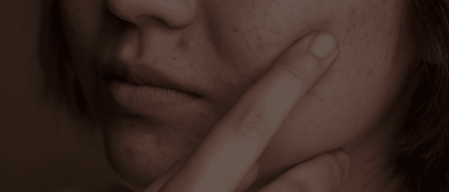 Acne Treatment in Bangalore