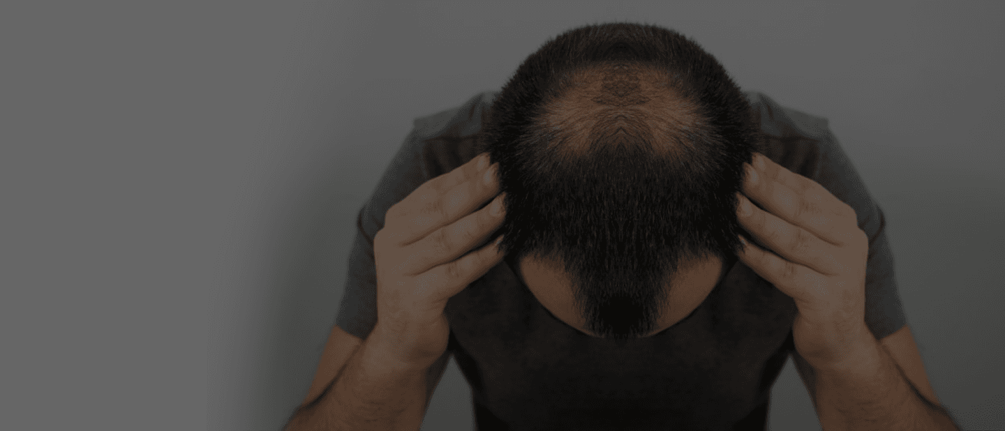 Hair Loss Treatment
