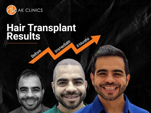 Gaurav Wasan’s Hair Transplant Journey: The Results That Truly Restored His Confidence